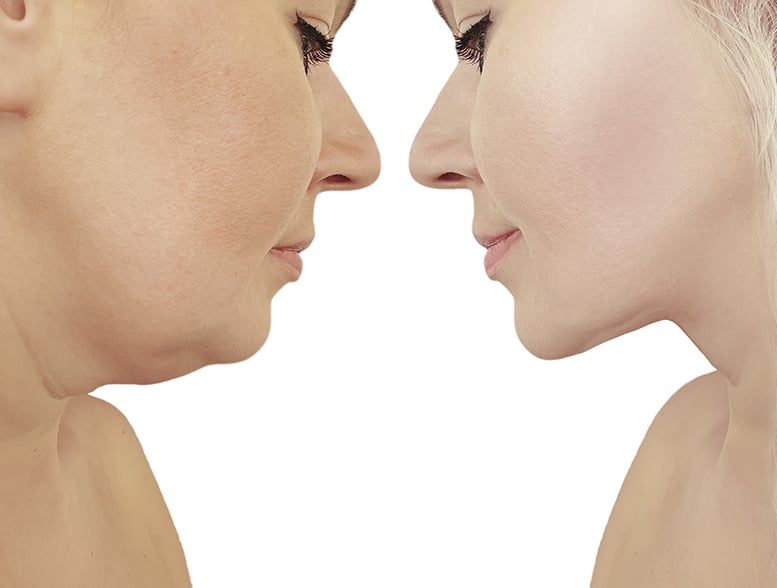 Facial & Neck Liposuction