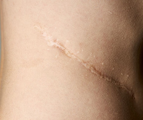 scar repair