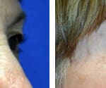 Blepharoplasty Before & After