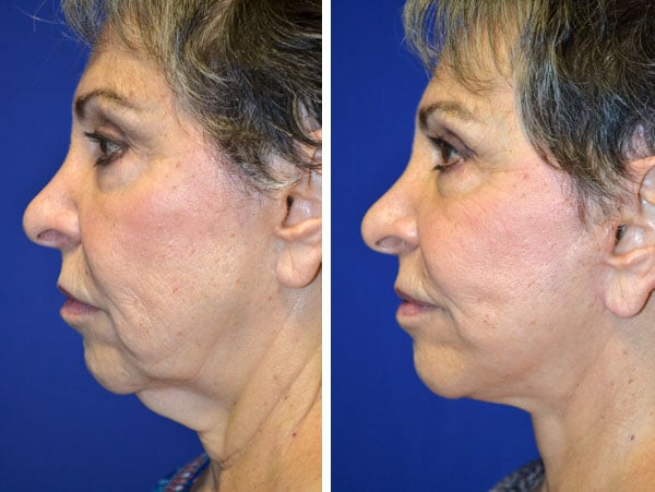 Cheek & Neck Before & After